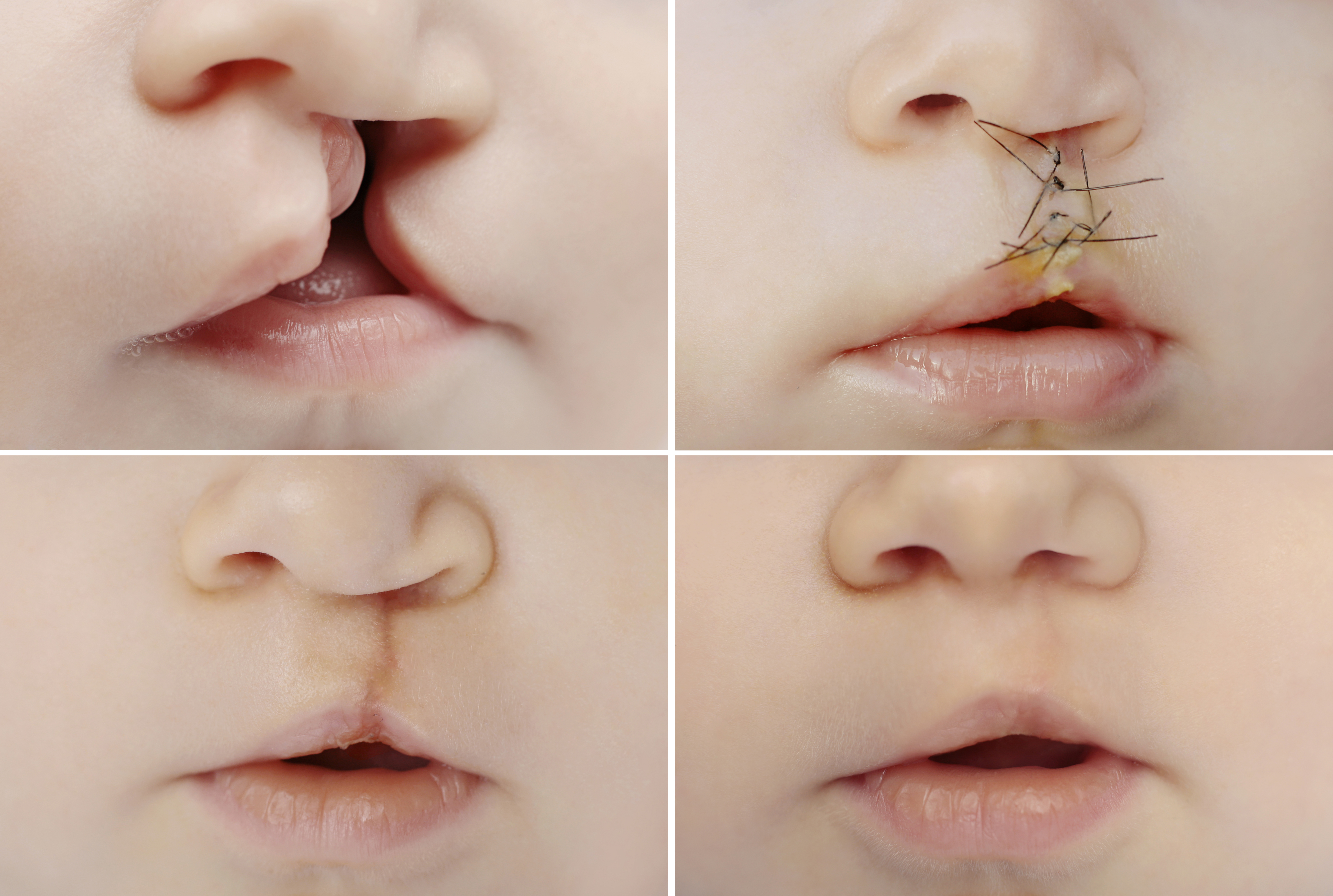 Barn med læbe- og ganespalte før og efter operation